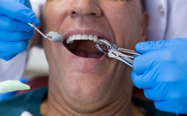 На фото – стоматолог удаляет зуб